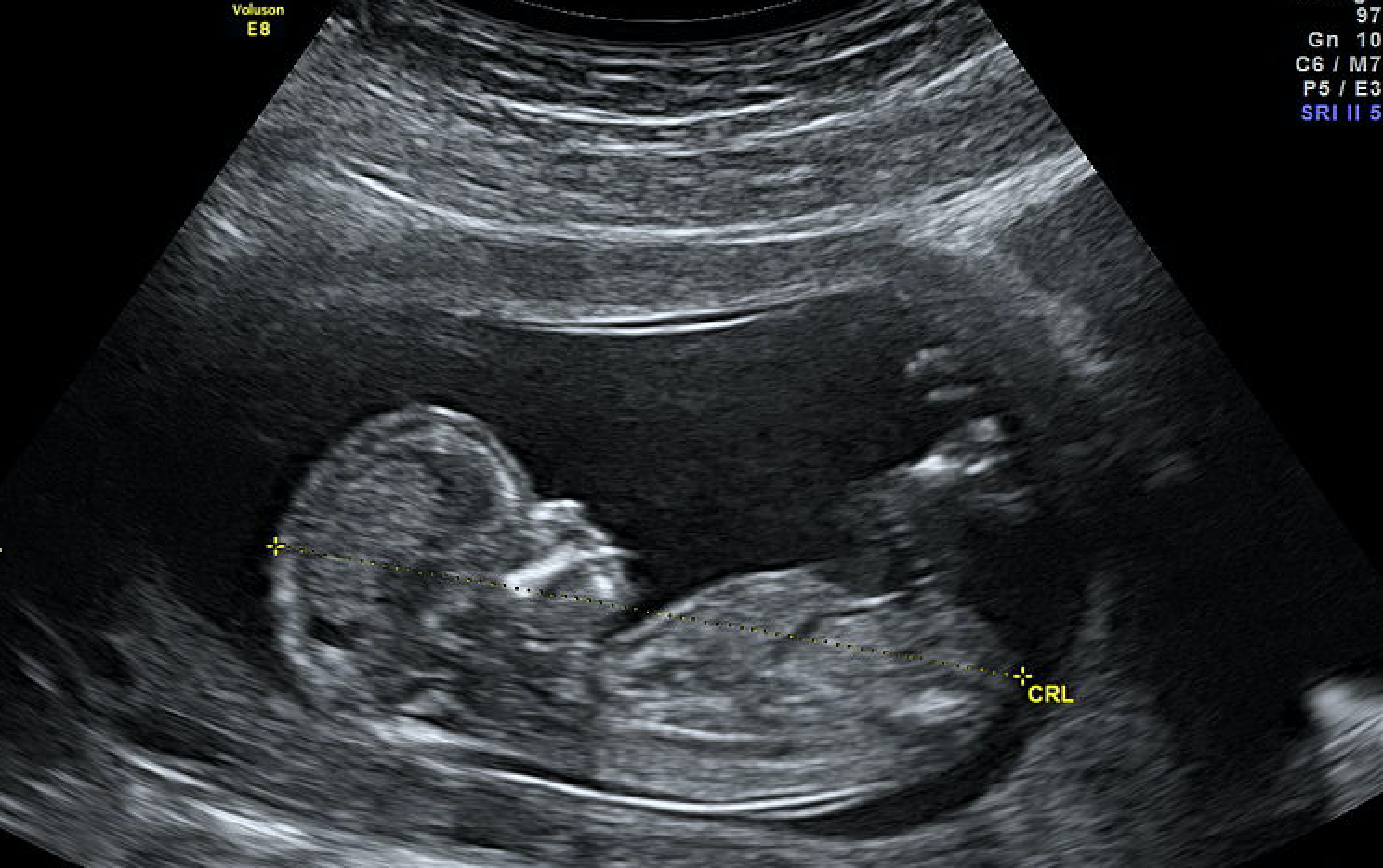 ultrasound of a baby